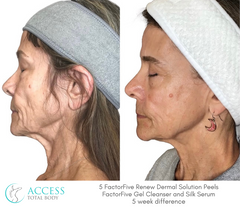 FactorFive Skin Therapy Package (Series of 4)