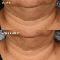The Max Neck Lift